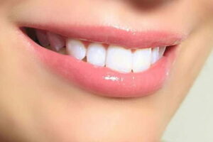 Clareamento dental com fita