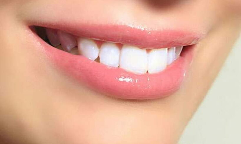Clareamento dental com fita