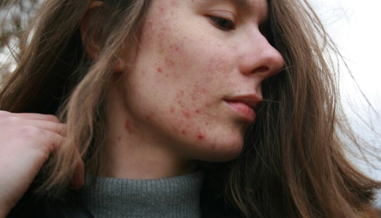 Cicatrizes de acne